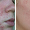 Skin Accumax - Image 2
